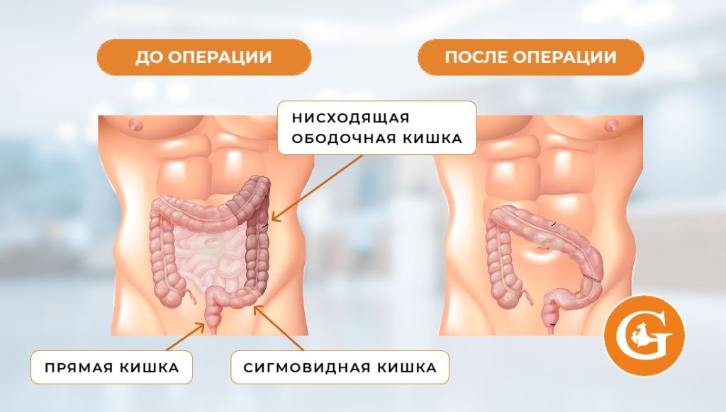 Левосторонняя гемиколэктомия Левосторонняя гемиколэктомия