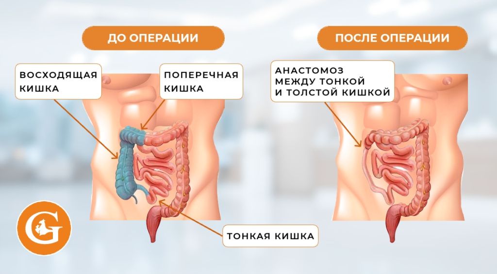 Гемиколэктомия правосторонняя Гемиколэктомия правосторонняя
