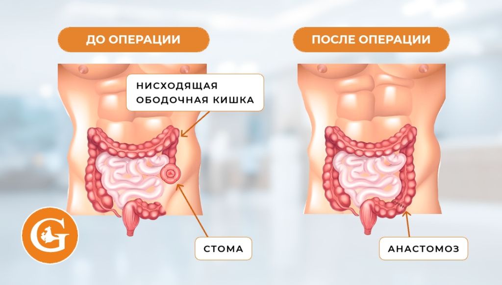 Гемиколэктомия левосторонняя с формированием колостомы Гемиколэктомия левосторонняя с формированием колостомы