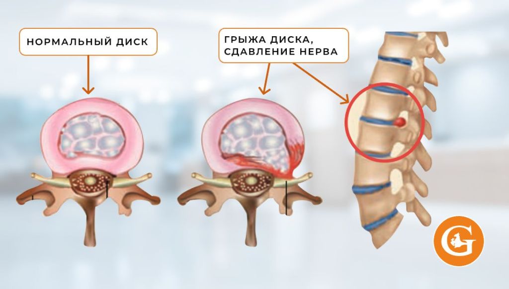 Микрохирургия грыжи Микрохирургия грыжи